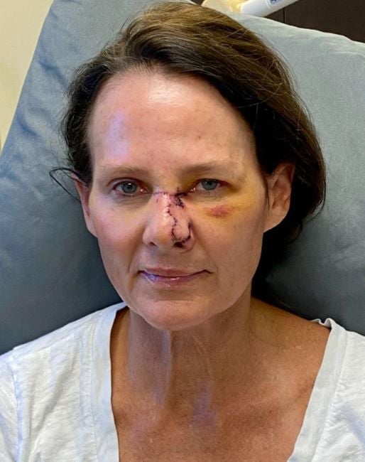 A picture of Kathy Sabine after her skin surgery (2022)
