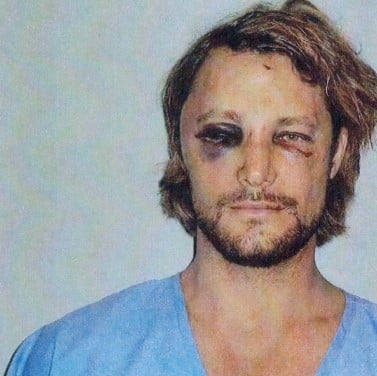 A viral picture of Gabriel Aubry after a fight with Olivier Martinez Halle at Berry