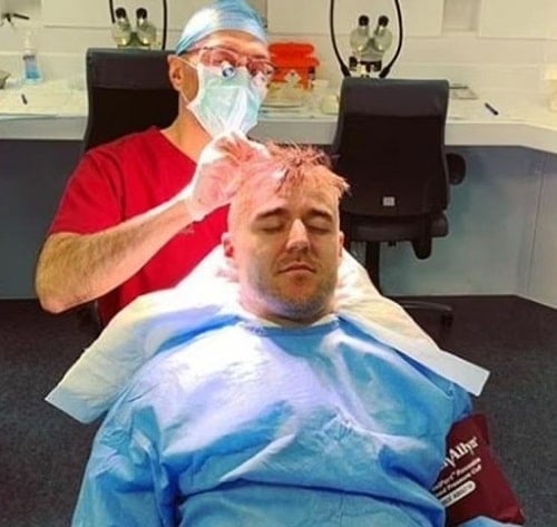 Alan Halsall getting hair transplant