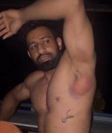 An injury in lats of Rajat Dalal