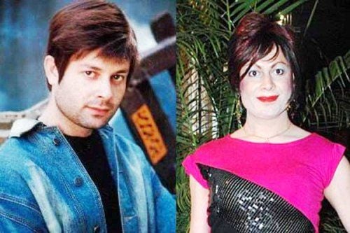 Bobby Darling before and after surgery