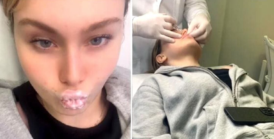 Jasmine Carrisi during her lip filler surgery