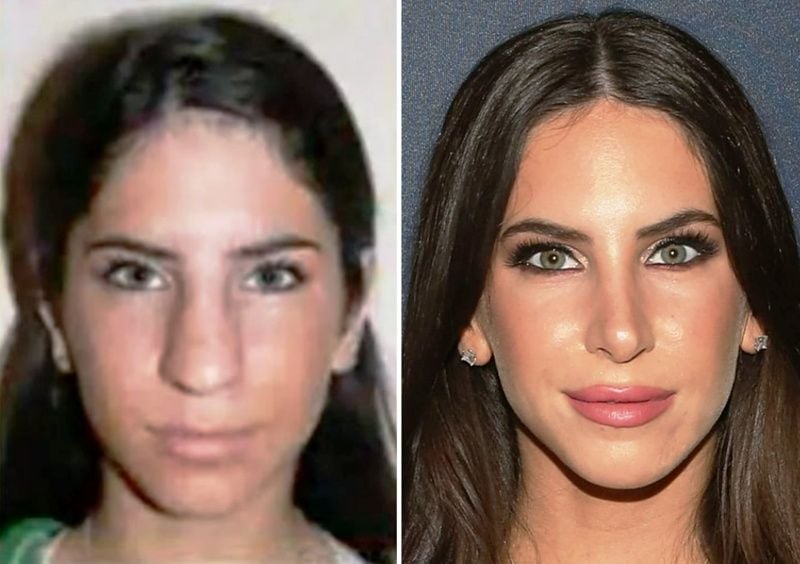 Jen Selter before and after nose surgery
