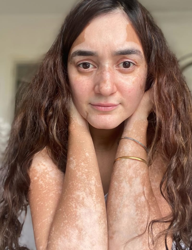 Karishma Kohli flaunting her vitiligo patches