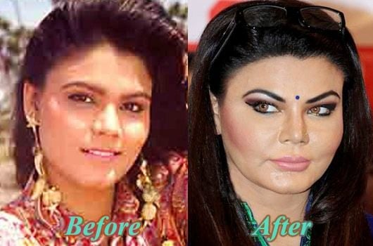 Rakhi Sawant Before And After